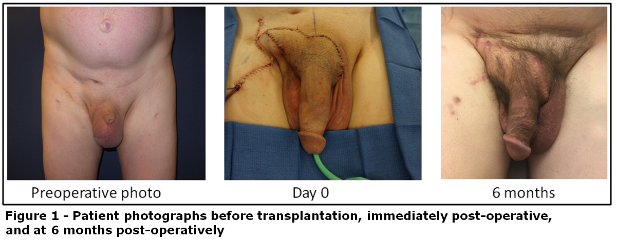 First Penis Transplant 82