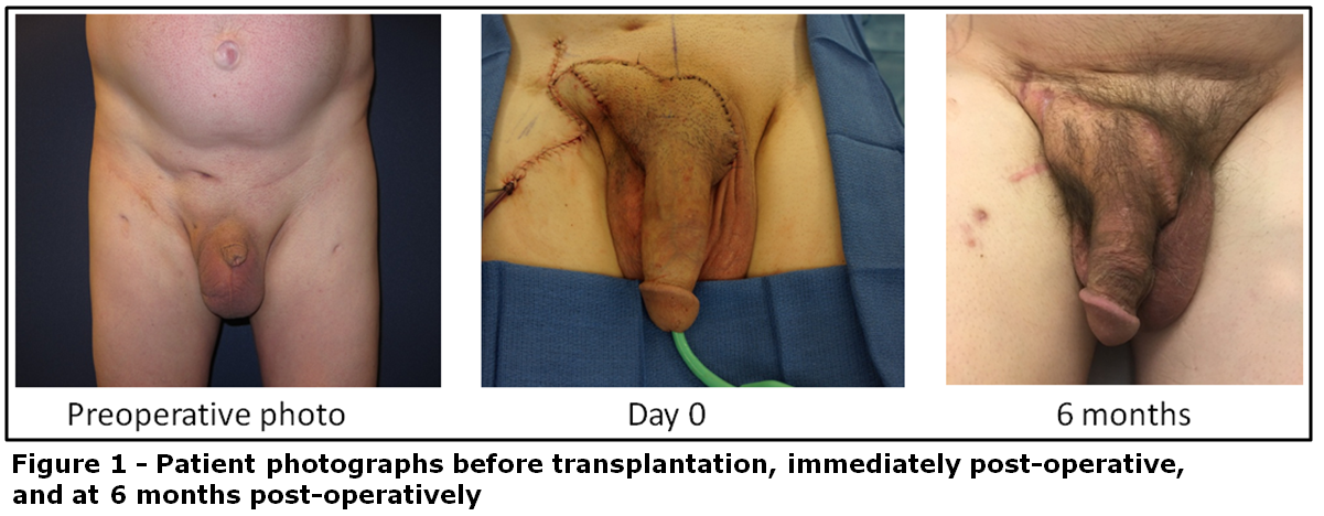 Penis Transplantation 81